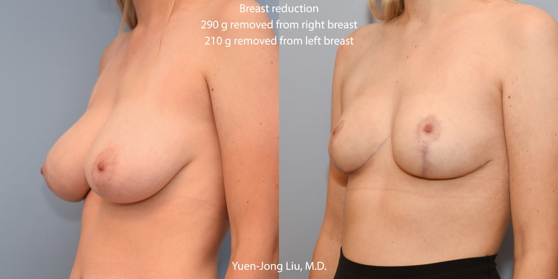 breast-reduction-obl.jpg