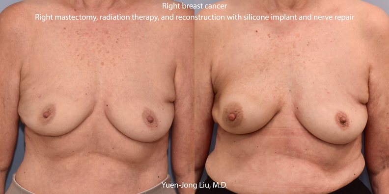 Breast Reconstruction with Silicone Implant
