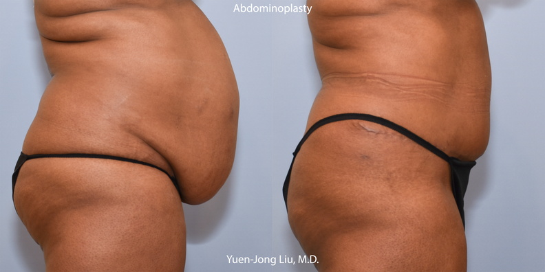 abdominoplasty-lat.jpg