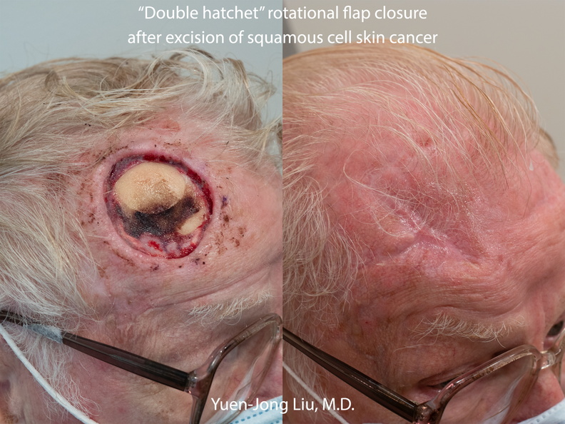 Forehead Reconstruction with Double Hatchet Flaps
