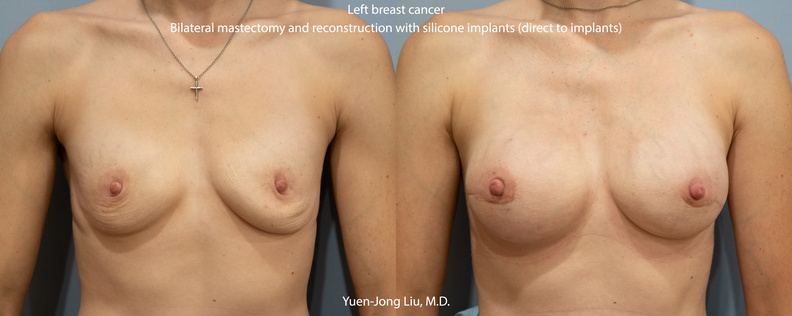 Breast Reconstruction with Silicone Implants (Direct to Implants)