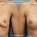 Breast Reconstruction with Silicone Implants (Direct to Implants)