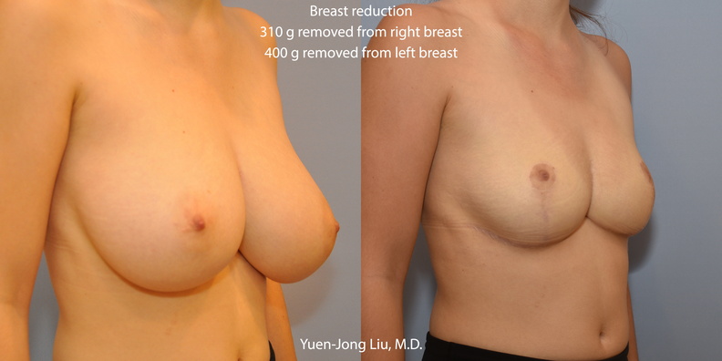 breast-reduction-obl.jpg
