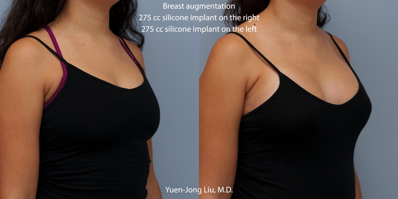 breast-augmentation-obl.jpg