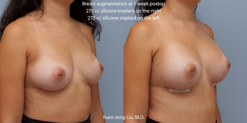 breast-augmentation-obl.jpg