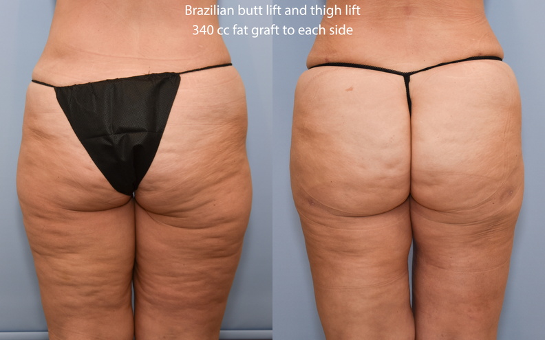 Brazilian Butt Lift & Thigh Lift