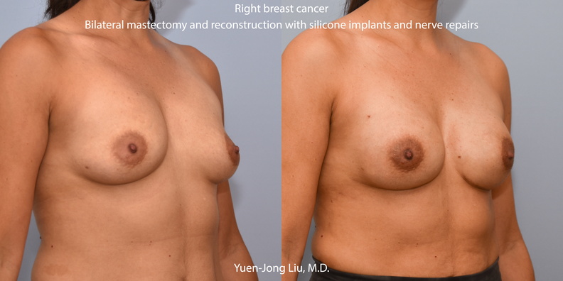 breast-recon-obl.jpg