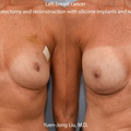 Breast Reconstruction with Silicone Implants