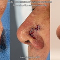 Nasal Reconstruction with Rotation Flap