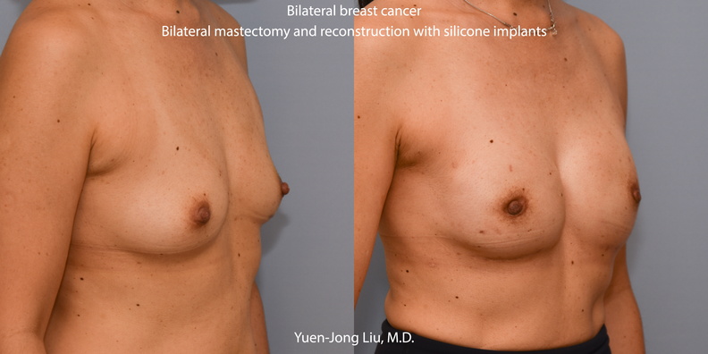 Breast Reconstruction with Silicone Implants